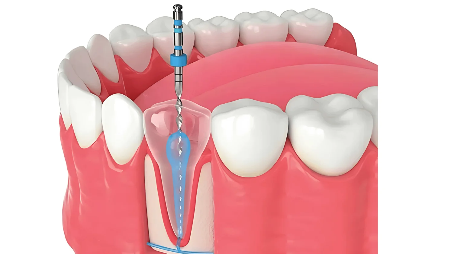 Durational root canal fee