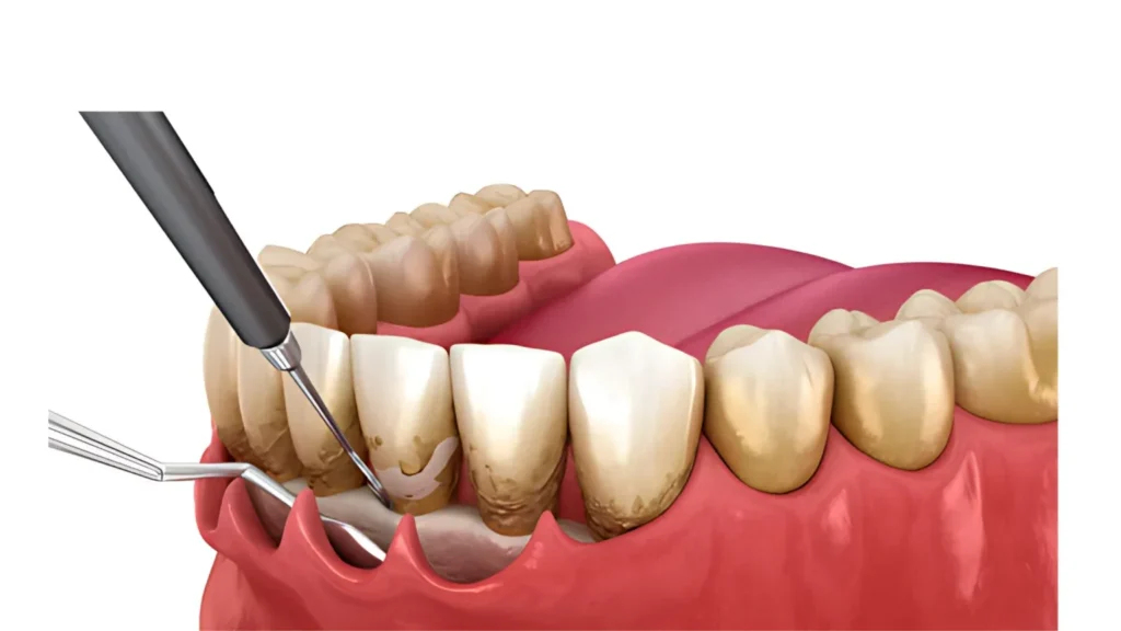 牙周病治療 Compressed