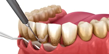 牙周病治療 Compressed
