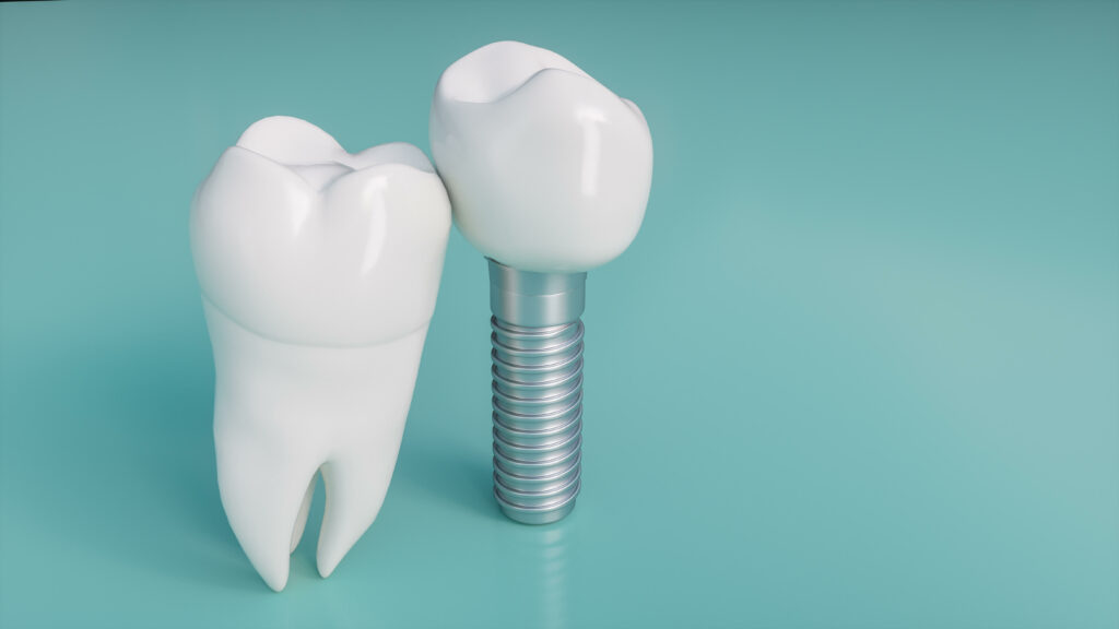 Dental Implant | Implant Hong Kong｜Dental Implant Process- Excelsior Dental