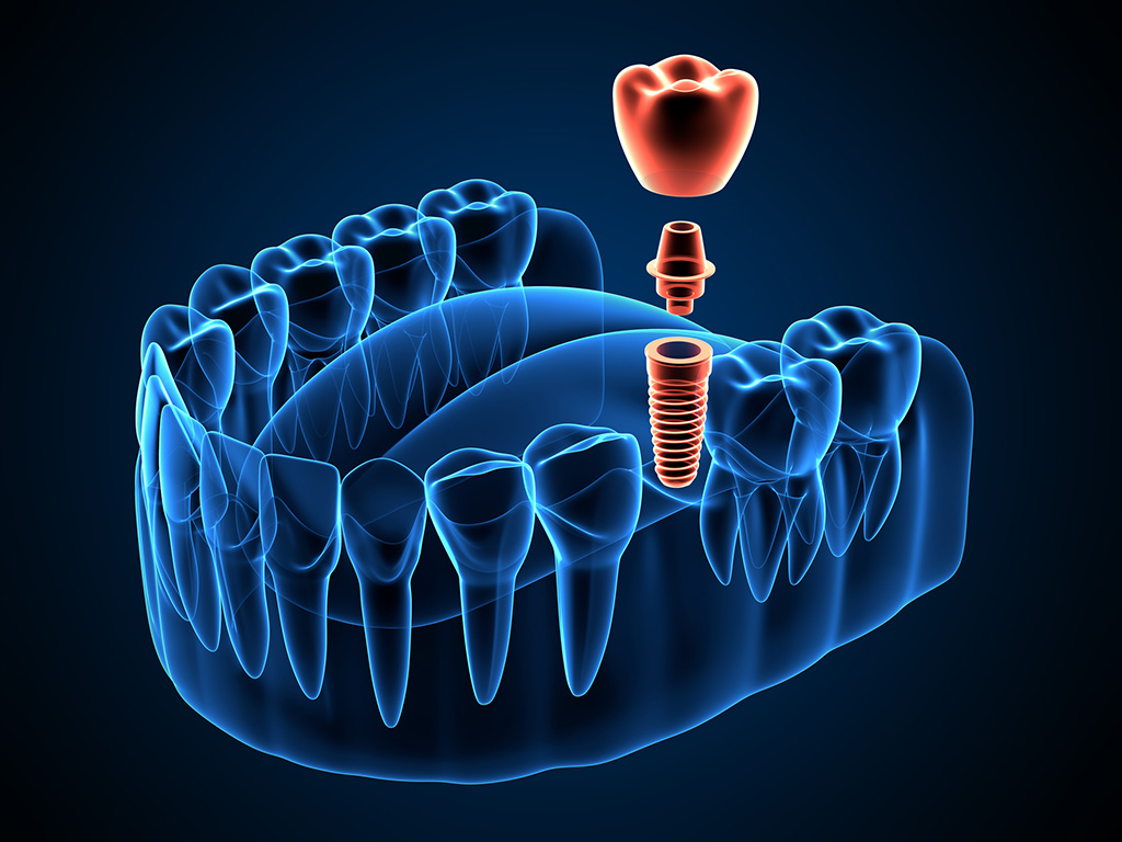 Dental implant | Clínica Dental Baldrich